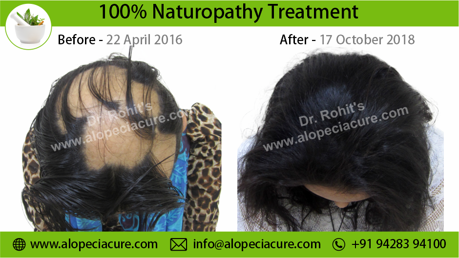 Alopecia Areata Result 6